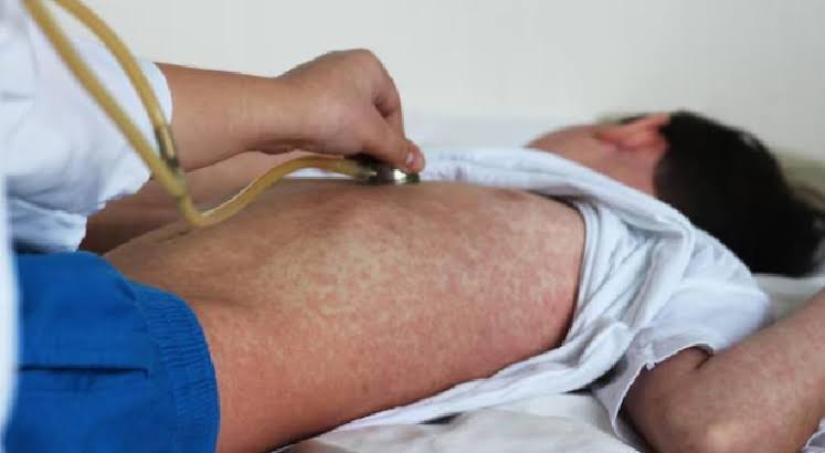 Confirma Salud más de 3 mil 512 pacientes recuperados de sarampión